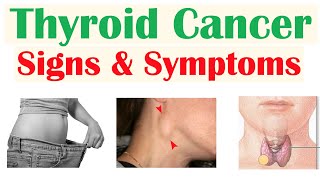 Thyroid Cancer Signs amp Symptoms amp Why They Occur [upl. by Legnalos]