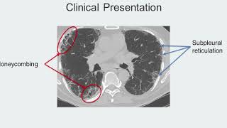 Honeycombing Track H Stop 3 IPF Navigating a Complex Disease [upl. by Anaet]