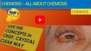 CHEMOSIS ALL ABOUT CHEMOSIS What is chemosis Causes of Chemosis Treatment of Chemosis [upl. by Rodger]