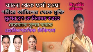 মুখ ফর্সা মুখে ব্রণ আঁচিলের জন্য হোমিওপ্যাথিক ট্রিটমেন্ট।।Homeopathic treatment for fair face acne [upl. by Gerardo]