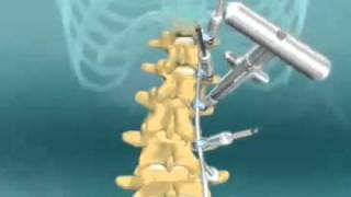 Scoliosis Spinal Fusion Animation [upl. by Zavras32]