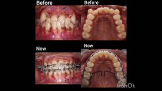 Progress in orthodontic treatment [upl. by Brocklin]