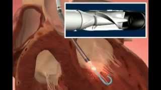 Impella Heart Pump [upl. by Hurwitz]