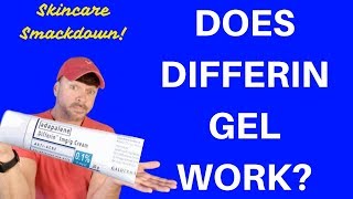 Differin Gel Review  DOES IT REALLY WORK  Chris Gibson [upl. by Irved]