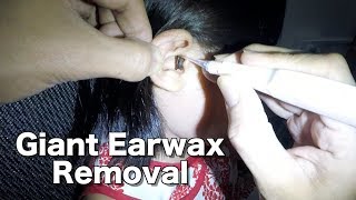 4 Year Old Girls Giant Earwax Removal [upl. by Ely]