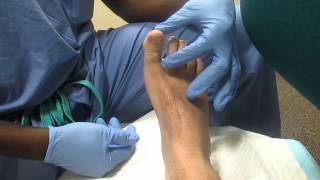 Hallux Block MWMC Podiatry [upl. by Akerdna]