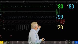 Philips IntelliVue Patient Monitoring  4  Changing Wave Order [upl. by Hannibal]