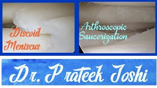 Arthroscopic Saucerization Partial Meniscectomy  Discoid Lateral Meniscus  Dr Prateek Joshi [upl. by Cosette]