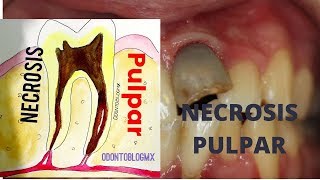 Necrosis pulpar [upl. by Berwick]