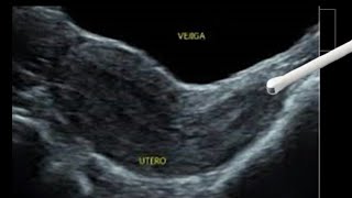 Ultrasonido endocavitario y transabdominal UTERO ISTMO UTERINO Y CERVIX [upl. by Lad]