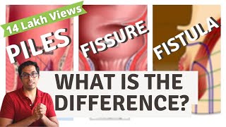 Piles  Fisure  Fistula  Difference explained  Dr Vishal Tomar  Open Consult [upl. by Thisbe]