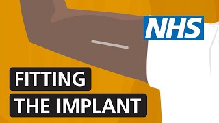 Fitting the contraceptive implant  NHS [upl. by Linnie]