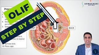 Arthroscopic Posterior Labral Repair  Randy S Schwartzberg MD [upl. by Naget]