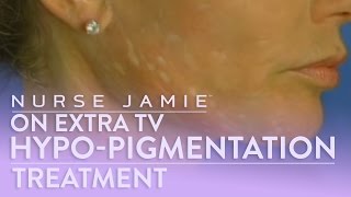 Hypopigmentation Treatment  Nurse Jamie on Extra TV [upl. by Anastas]