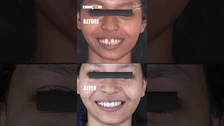 Before and After Dental Braces and Aligner Treatment  Should be Done by Orthodontist Only shorts [upl. by Bernetta]