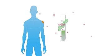 The 4 Types of Prostate Cancer Treatment  Prostate Cancer Staging Guide [upl. by Nim839]