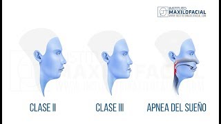 Corrective Jaw Orthognathic Surgery Animation [upl. by Baese]