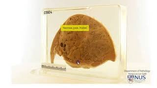 Liver  Hepatoblastoma [upl. by Lanaj]