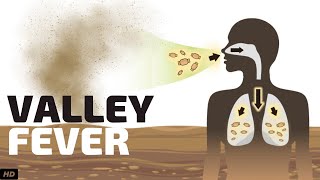 Valley Fever Causes Signs and Symptoms Diagnosis and Treatment [upl. by Uyekawa]