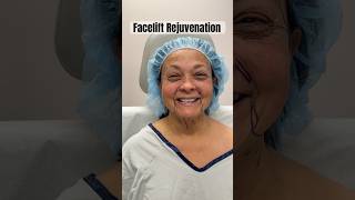 Patient Looks Years Younger After Facelift [upl. by Happy]