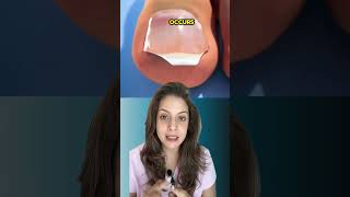 How to Treat Ingrown Nail  Nipun Kapur [upl. by Arodoet]