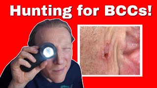 BCC Basal Cell Carcinoma Skin Cancer What You NEED to KNOW [upl. by Feodor]