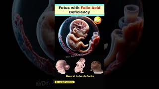 How Folic Acid Deficiency Leads to Neural Tube Defects in Pregnancy shortsviral pregnancy vitamin [upl. by Eire]