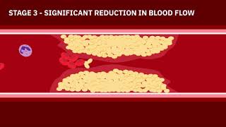 Coronary Artery Disease Animation [upl. by Yentihw]