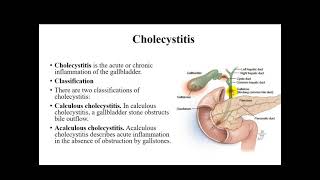 management of cholecystitis and cholelithiasis [upl. by Ecyor]