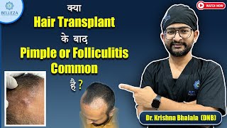 क्या hair transplant के बाद pimple or folliculitis common है   Drkrishna bhalala  belleza clinic [upl. by Huston569]