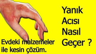 Yanık Acısı Nasıl Geçer  evdeki malzemeler ile [upl. by Rudie136]