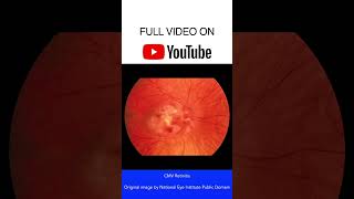 CMV Retinitis Fundoscopy [upl. by Haiacim]