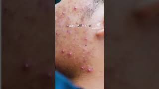 Top pharmacy products Clogged pores Acne  pigmentationread discription for disclaimer facedecor [upl. by Dnalyr]