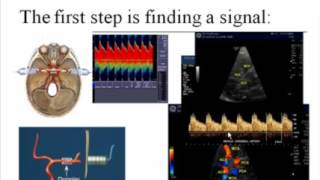 An Introduction to Transcranial Doppler [upl. by Elagiba]