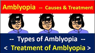 Amblyopia causes and treatment causes types and treatment amblyopia amblyopiatreatment [upl. by Kire]