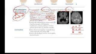 Neural tube defects Brain malformations  Neurology  2  First Aid USMLE Step 1 [upl. by Jonme]