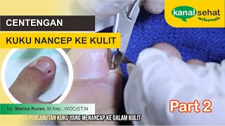 Pemotongan Kuku Cantengan Jempol Kaki  Part 2 [upl. by Adallard]