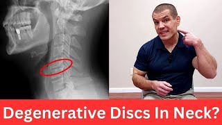 3 Exercises For Cervical Degenerative Disc Disease Relieve Neck Pain [upl. by Warthman]