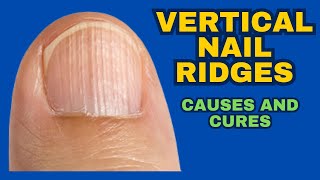 Natural remedies to treat vertical nail ridges [upl. by Jasik]