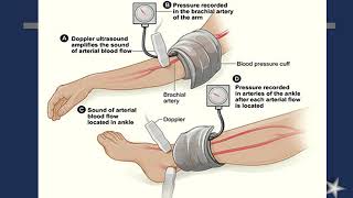 Arteriosclerosis Obliterans Peripheral Vascular Diseases [upl. by Celinda542]