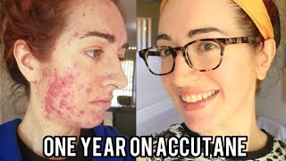 ACCUTANE Before And After Severe Acne With Pictures My Experience  Jess Bunty [upl. by Meirrak]