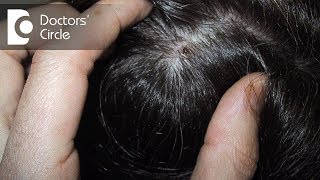 How can one manage scabs on scalp with itching white flakes amp dryness  Dr Rashmi Ravindra [upl. by Aisul]