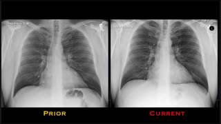 Pneumonia Explained by Prometheus Lionhart MD [upl. by Knute]