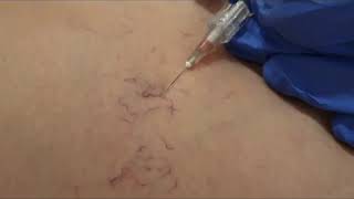 Traitement des varices et varicosités par Sclerotherapie  علاج دوالي الساق بالتصليب و الحقن [upl. by Jarnagin]