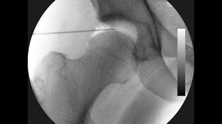 Minimally Invasive Total Hip Replacement  THR  Nucleus Health [upl. by Sillsby]