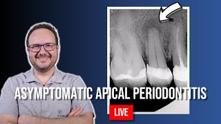 Endo Treatment of Asyntomatic Apical Periodontitis of 15  Part 1 [upl. by Mccord662]