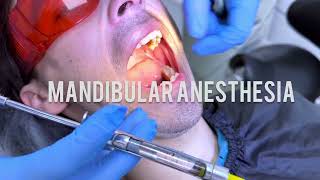 Techniques for Mandibular Anaesthesia  VaziraniAkinosi Mandibular Block Technique dentist dental [upl. by Arihat]