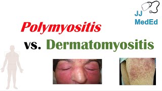 Idiopathic Inflammatory Myopathies  Polymyositis vs Dermatomyositis [upl. by Atteloiv]