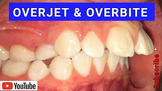 Overjet amp Overbite  Causes amp Treatment Using Braces amp Invisalign [upl. by Ahsauqram752]