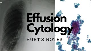 Effusion Cytology Kurt’s Notes pathagonia [upl. by Patterson994]